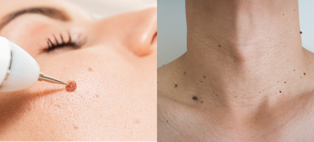 Warts Treatment